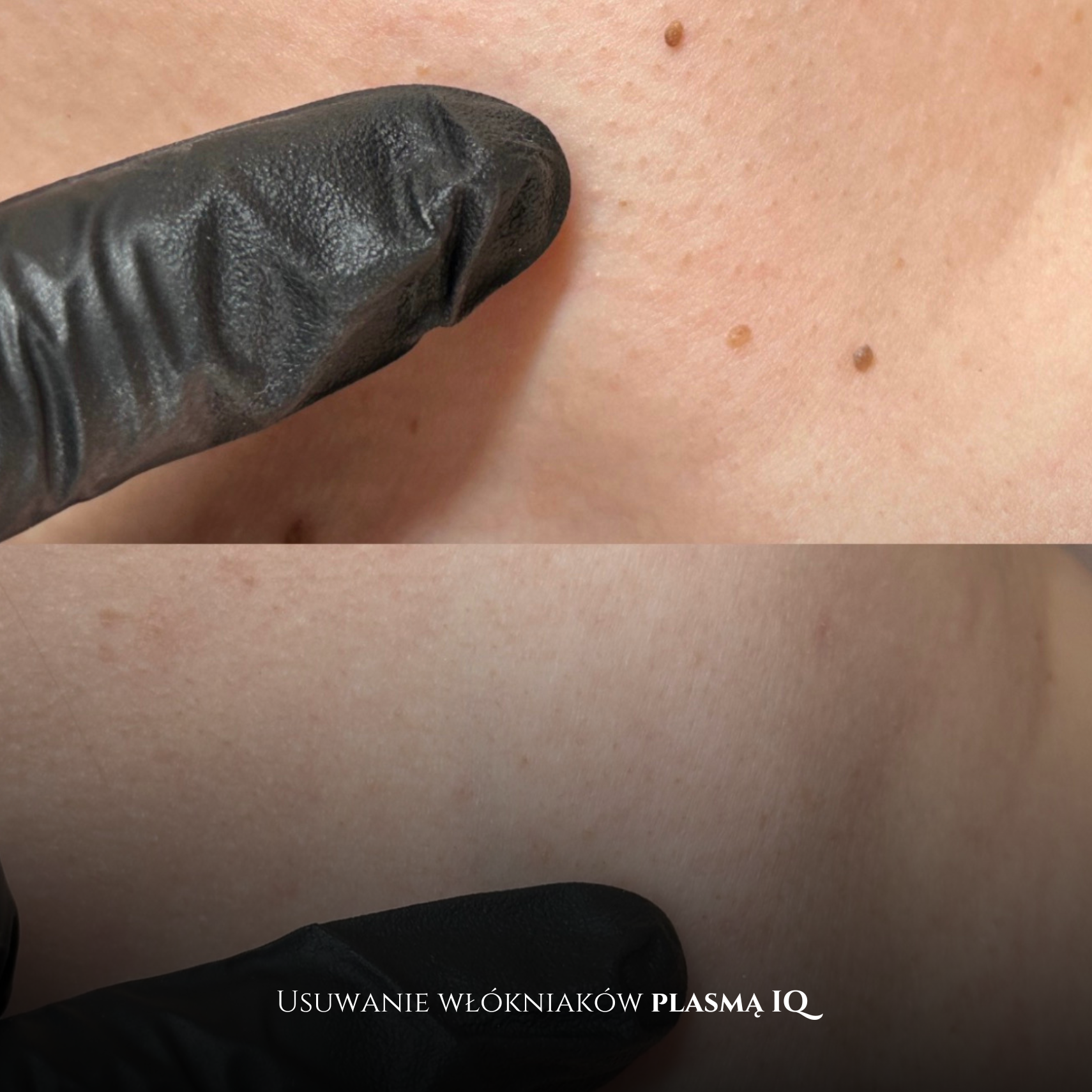 skóra reaktywna, brak końcówek